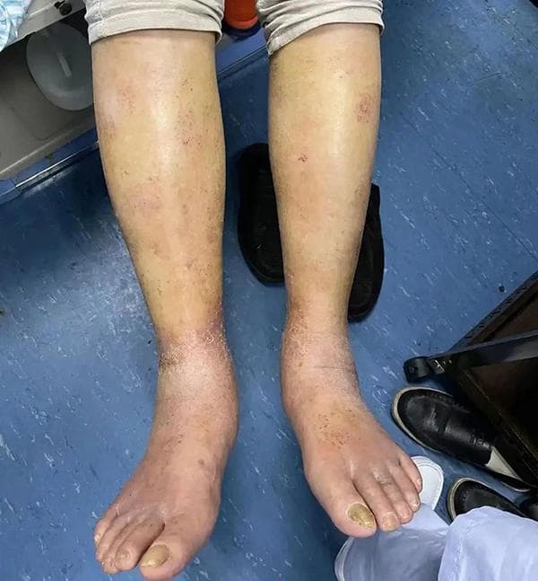 【科普】水肿的分类及其常见原因