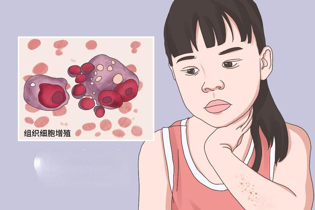朗格汉斯组织细胞增多症