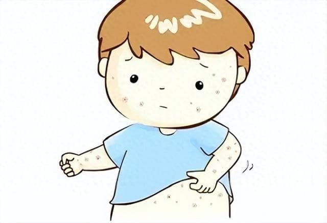 吡美莫司乳膏：不含激素，宝宝特应性皮炎首选