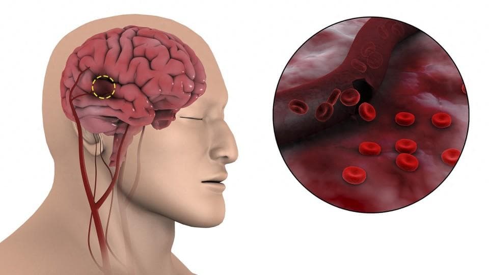 68%脑梗死患者，发病前1年出现过脑供血不足，这些症状大脑在呼救