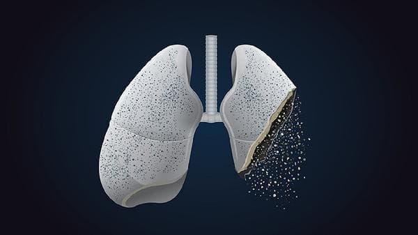肺部CT报告单解读：影像描述与诊断意见全解析