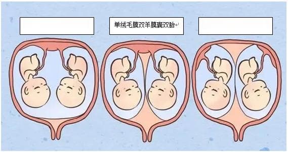 双胎、多胎妊娠风险及管理指南