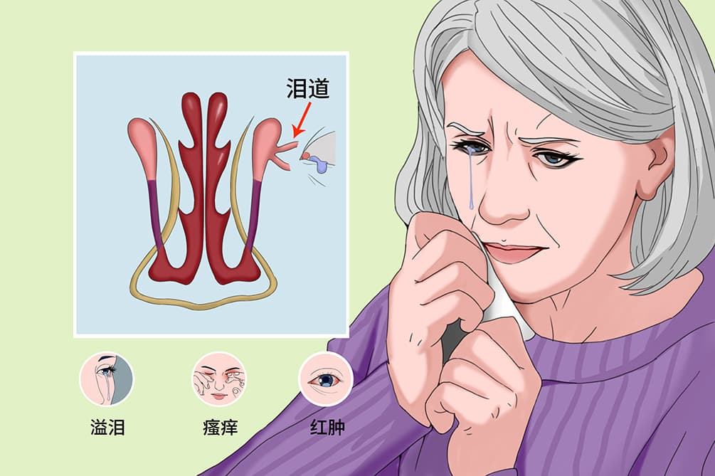 溢泪症：病因、症状与治疗全解析