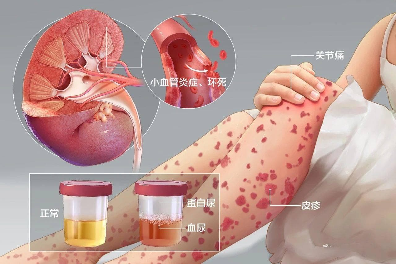 过敏性紫癜肾炎患者，平时需要关注哪些指标？
