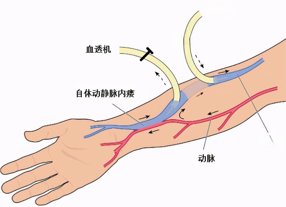 尿毒症血透患者的生命线——动静脉内瘘