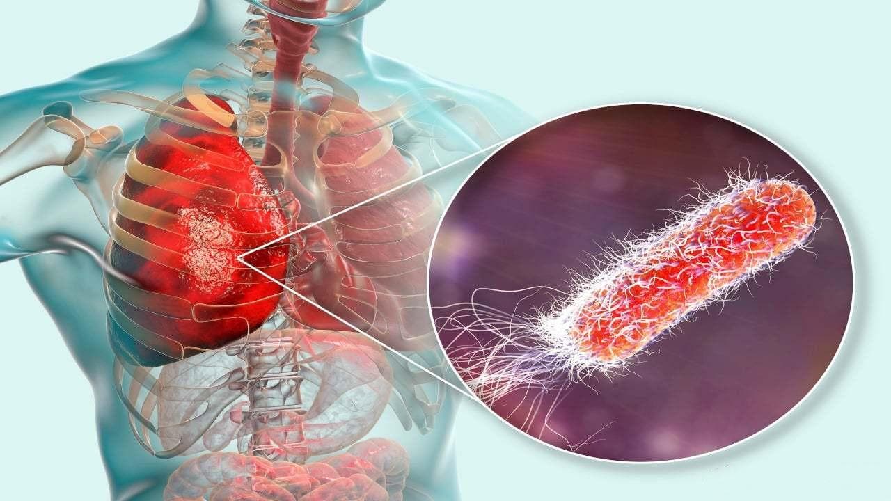 细菌性肺炎药物Fetroja（cefiderocol）的作用机制、疗效及安全性