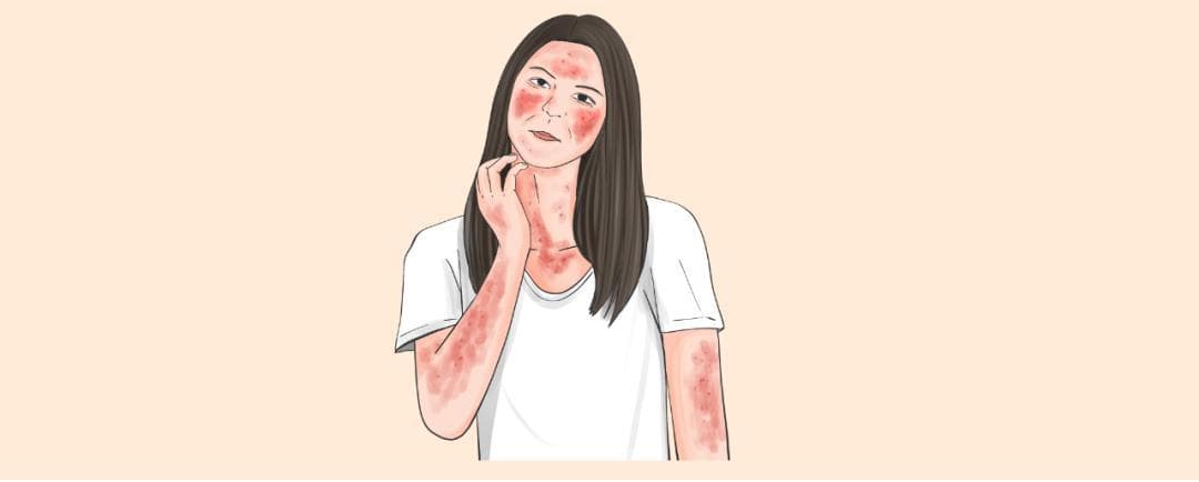 系统性红斑狼疮：症状、治疗与预防复发全解析