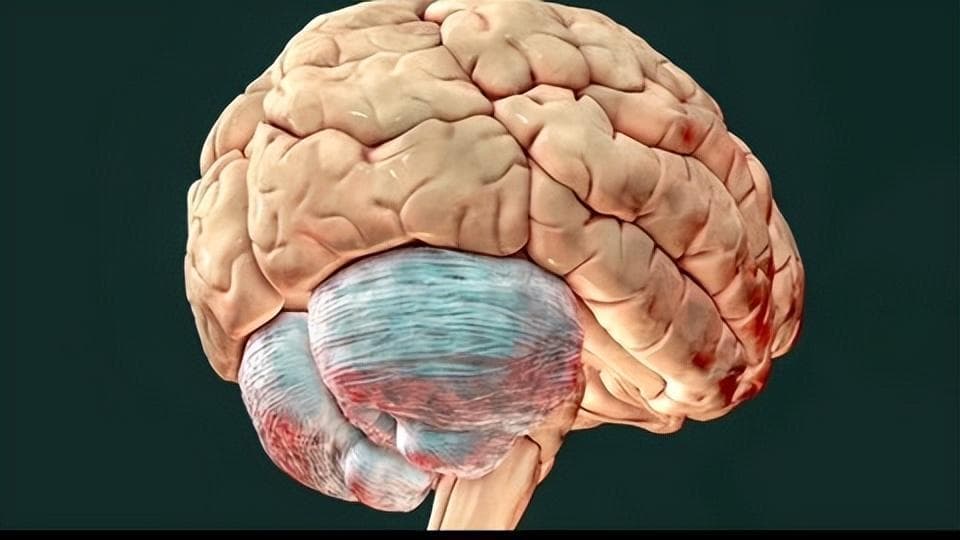 这些症状都是脑萎缩症状表现，7个因素都容易发病，做好早期预防