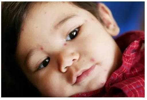 20种常见婴幼儿皮疹图文指南 | 教你轻松识别宝宝身上的小红点