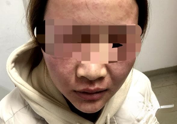 30天不洗脸皮肤会更好？杭州一男子试了一个月，脸皮变“树皮”