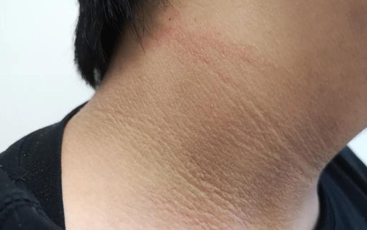 脖子上出现这个东西，可能是糖尿病的表现