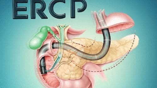 ERCP手术全解析：优劣势、风险与并发症