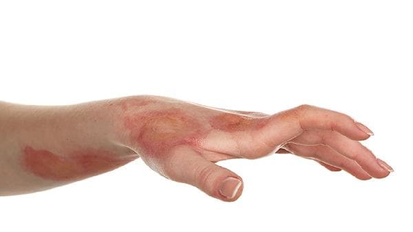 烧伤后可以用冰块冷处理吗？正确处理方法在这里