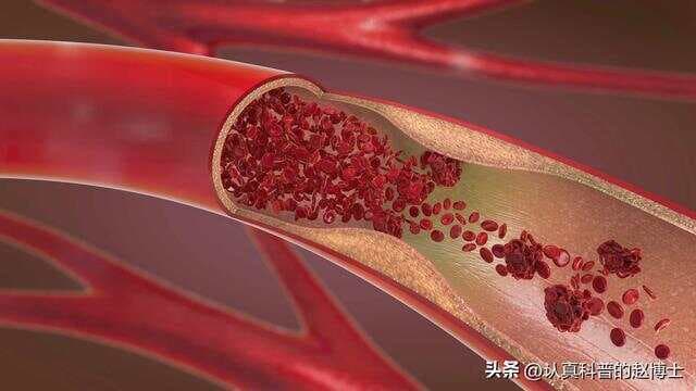 心梗风险降25%！协和心内科：这款“消炎老药”应加入冠心病治疗
