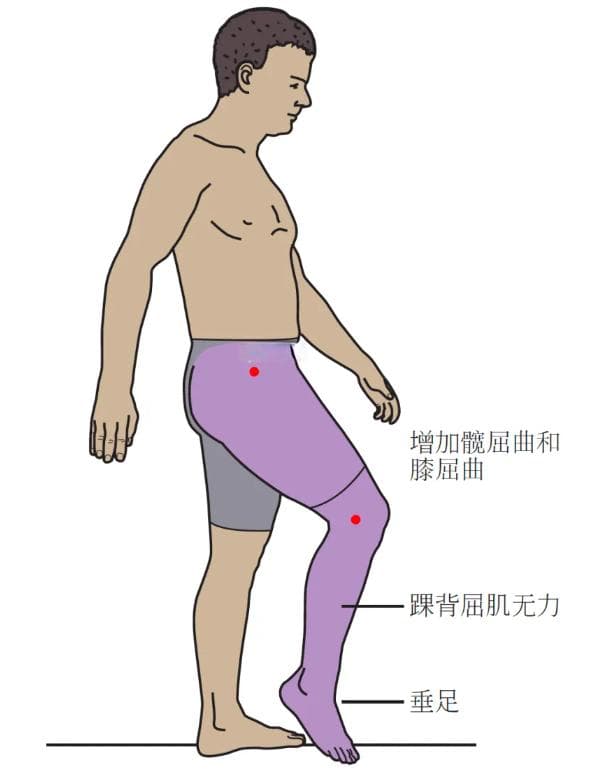 【评估与检查】膝关节的异常步态分析