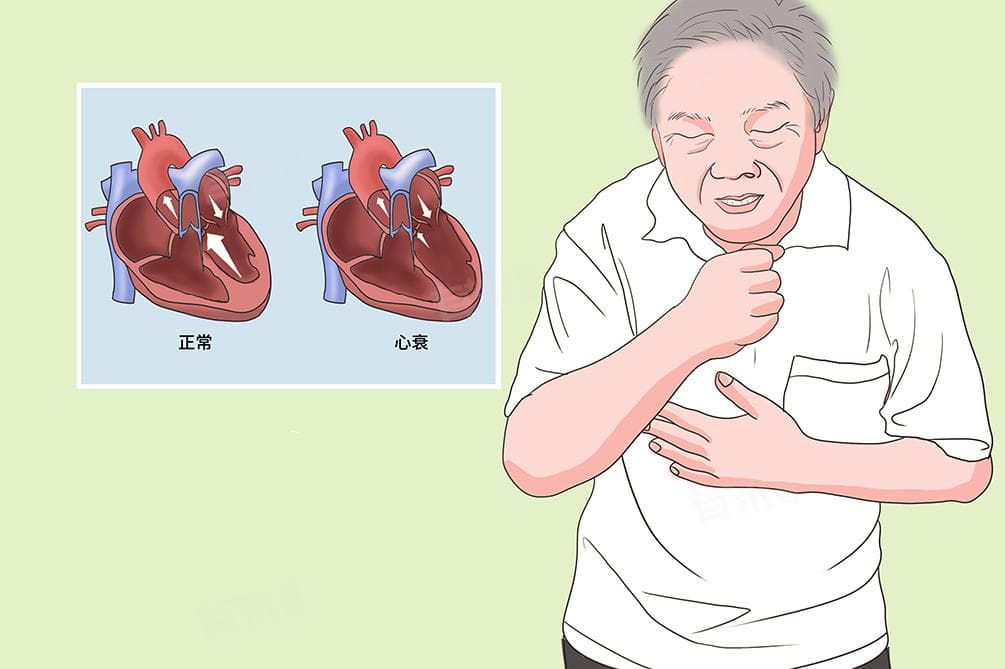心衰的病人能活多久