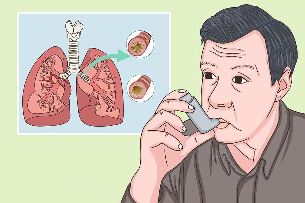 哮喘长期吸布地奈德可以吗