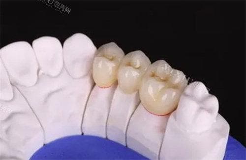 爱迪特和爱尔创全瓷牙的区别：从材料、适应症到用户评价的全方位对比