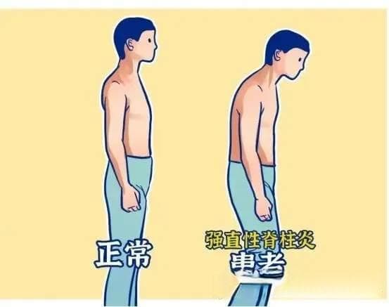 HLA-B27阳性一定是强直性脊柱炎吗？