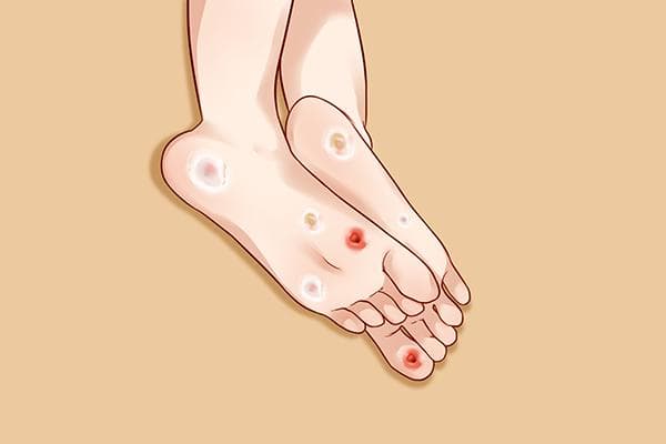 鸡眼贴是什么原理
