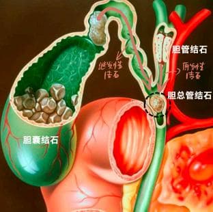【病案现场】隐匿杀手：胆管结石“隐痛”中的致命威胁