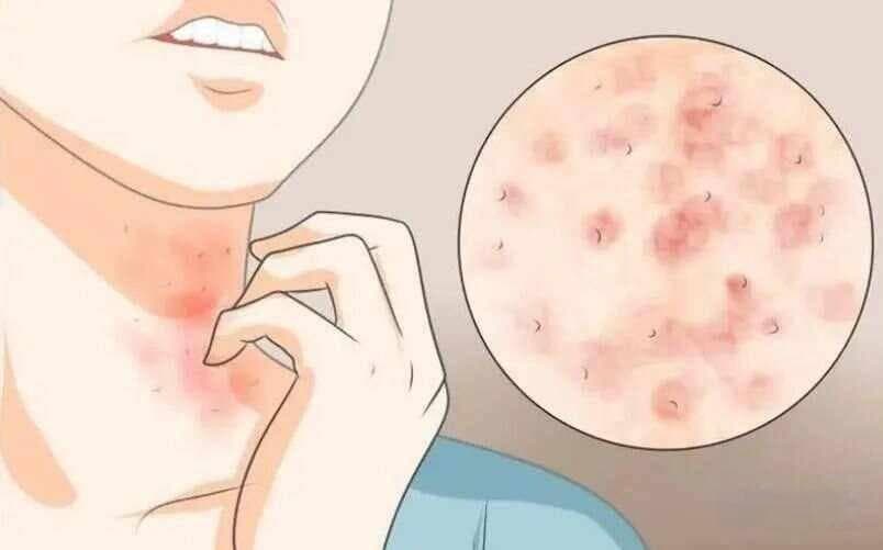 皮肤过敏反应：如何识别和有效处理