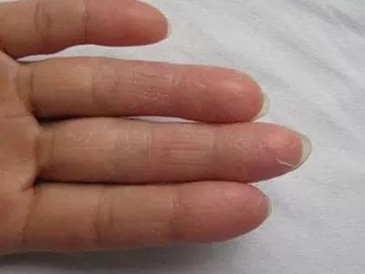 手部脱皮怎么办？海医一附院皮肤科专家详解原因与防治方法