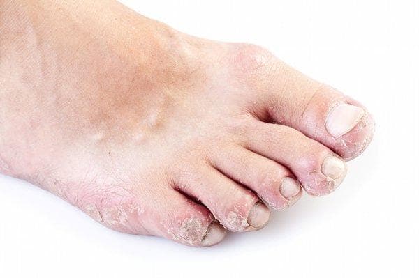 脚气好了后脚跟发黑