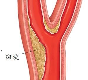 斑块和血栓：区别、危害与预防策略