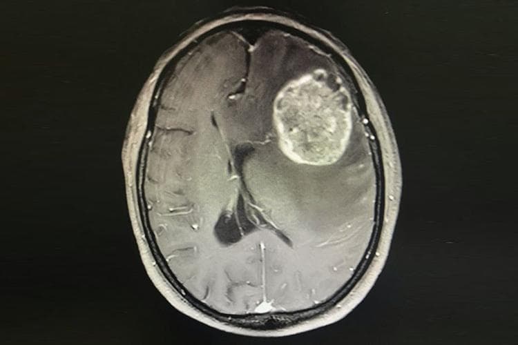 脑转移癌患者的生存期