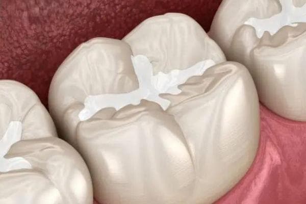 窝沟封闭有必要做吗？智商税有毒？看完原理和优势就明白了