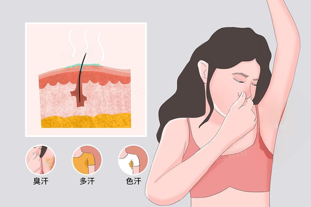 狐臭的治疗与预防方法