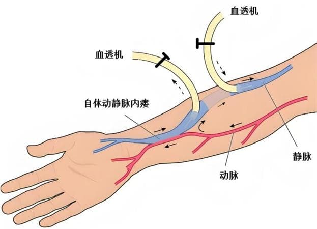 维护透析患者“生命线”畅通——超声引导下经皮静脉内瘘球囊扩张术（PTA）