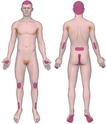 银屑病分型详解——慢性斑块型银屑病的临床表现与诊断