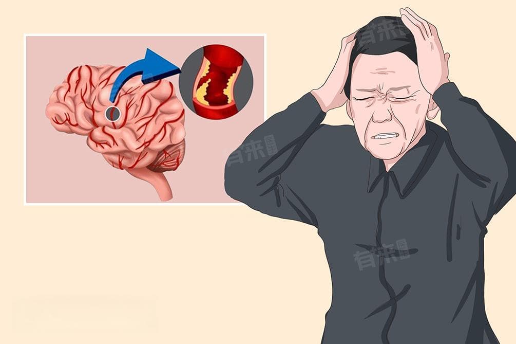 左侧椎动脉纤细是什么意思