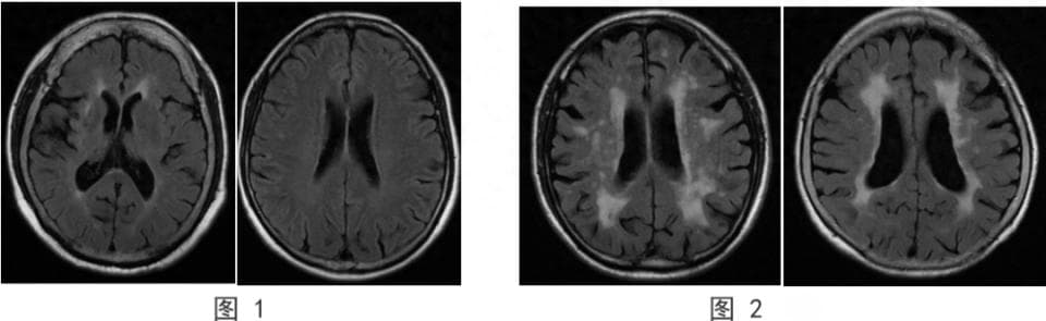 磁共振查报告“腔隙性脑梗死”，严重吗？一文说透不纠结