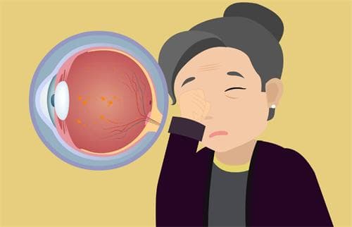 热敷眼睛/吃叶黄素飞蚊症没了?!真假?会有这种情况出现但仍需结合正规治疗