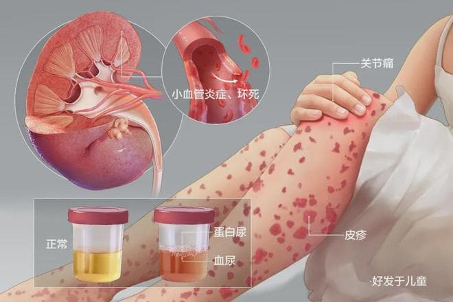 二次伤害的预防：如何避免过敏性紫癜患者皮肤感染？