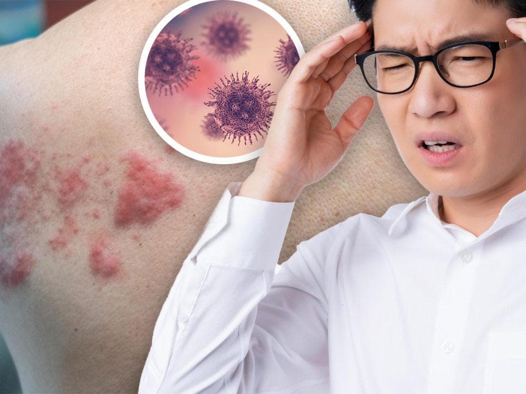 带状疱疹的认识与预防方法：守护健康从了解开始