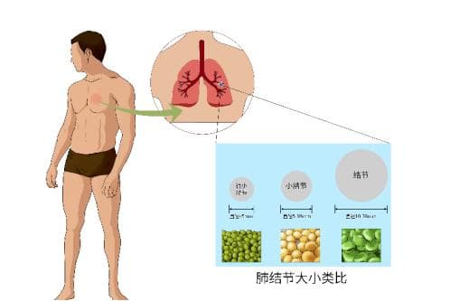 肺结节很常见，微创治疗有新篇——谈谈“消融术”