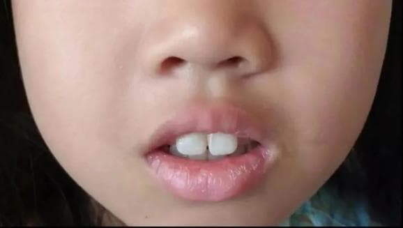 “总觉得儿子变丑了” 孩子腺样体肥大，一定要做手术吗？