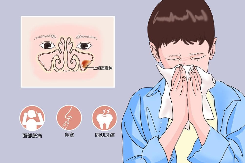 上颌窦囊肿