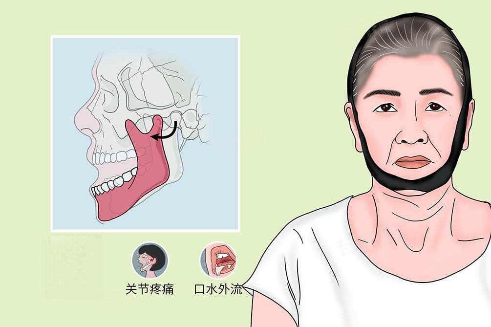 下巴脱臼了怎么办