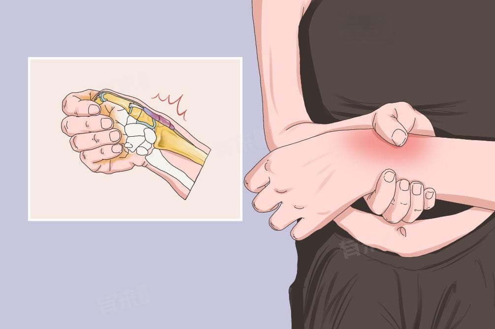 手腕腱鞘炎的正确锻炼方法