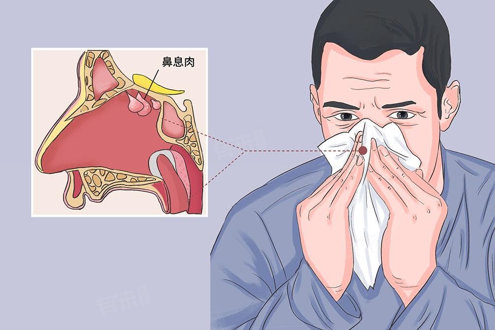 鼻息肉怎么办