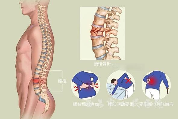 腰椎骨折健康教育