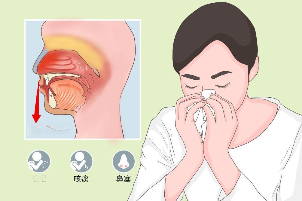 鼻后滴漏综合征