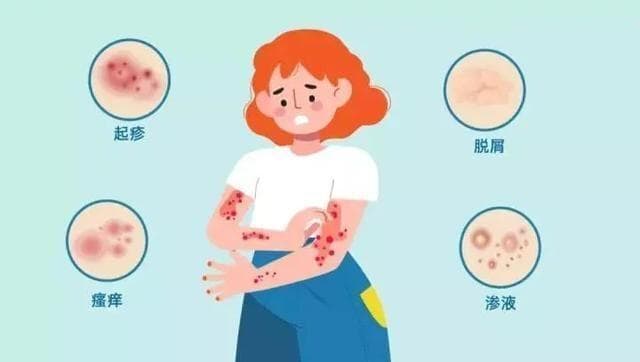 儿童使用醋酸氢化可的松乳膏全攻略：剂量、频率和注意事项