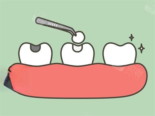 3M树脂补牙材料型号详解：从经济型到高端款，这些型号有何区别？