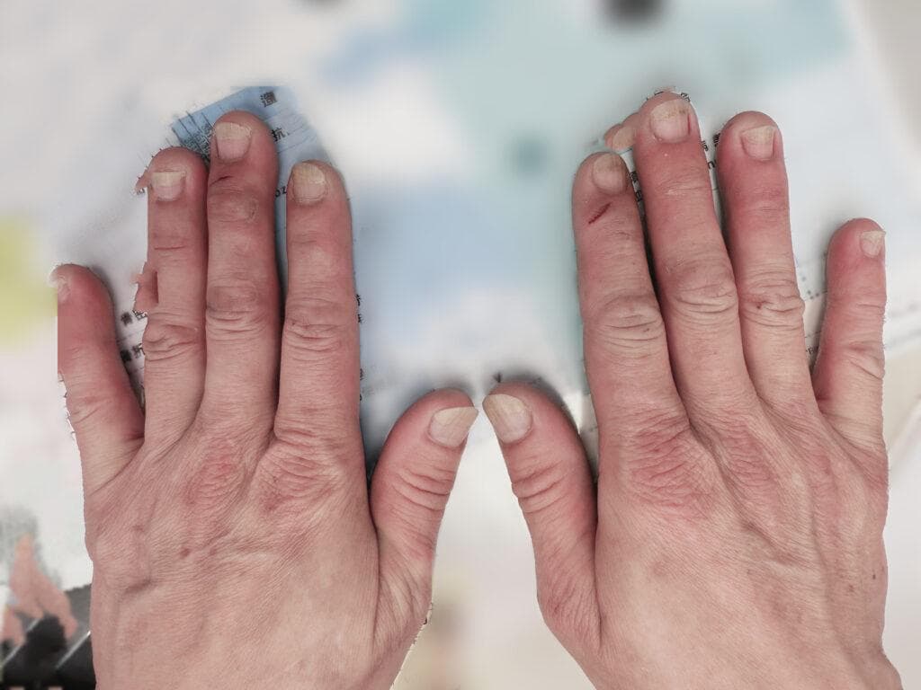 指甲如百叶窗般剥离？甲床剥离的警讯